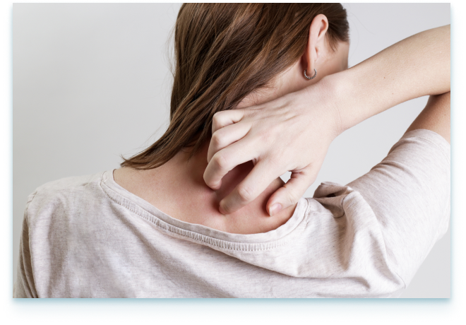 טיפול בפסוריאזיס