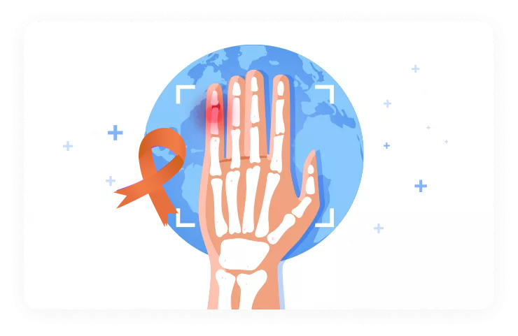 דלקת מפרקים פסוריאטית